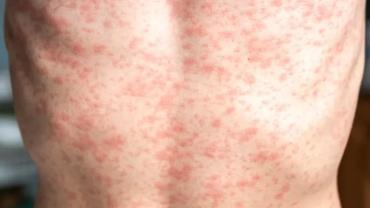 Infectologista alerta sobre importância da vacina para prevenir a reintrodução do sarampo no Brasil