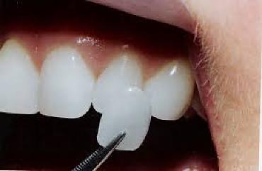 Clínica é condenada após erro em facetas dentárias causar dor e inflamação em paciente